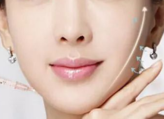 注射瘦臉針效果能保持多久