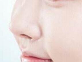 鼻翼縮小手術(shù)后會影響工作嗎