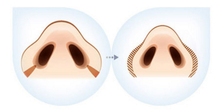 鼻翼縮小手術(shù)多久才能消腫