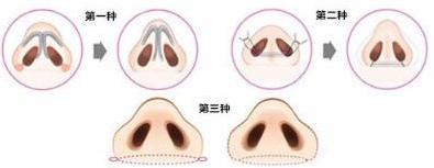 做鼻翼縮小手術(shù)前要什么準(zhǔn)備