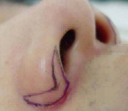 鼻翼縮小手術(shù)常見的風(fēng)險(xiǎn)