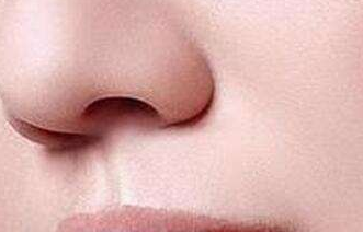 縮鼻翼手術(shù)安全嗎
