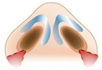  鼻翼縮小手術(shù)會有疤痕嗎