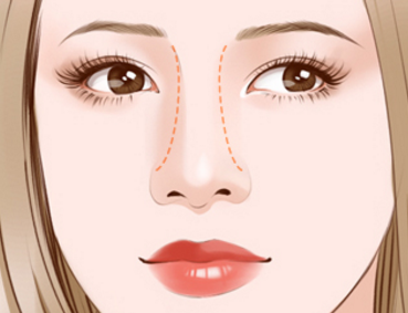 假體隆鼻術(shù)后的恢復期影響正常工作嗎