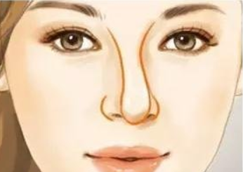 假體隆鼻歪了還能矯正嗎