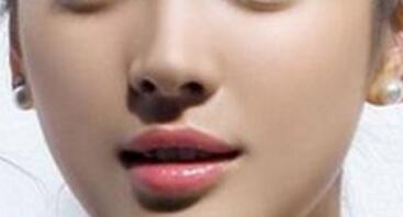 假體隆鼻失敗可以修復(fù)幾次