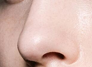 做隆鼻的恢復(fù)時(shí)間要多久