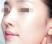 假體隆鼻痛不痛