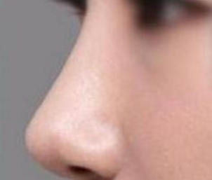 假體隆鼻恢復(fù)期間痛苦嗎