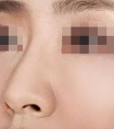 假體隆鼻歪斜了怎么辦