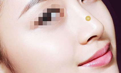 做自體軟骨隆鼻的價格費用