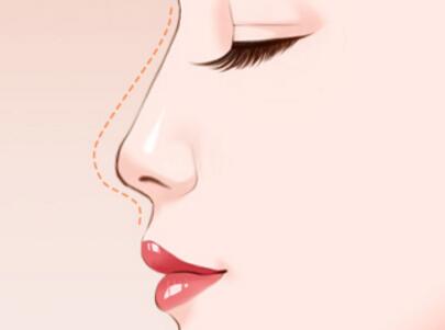 做自體軟骨隆鼻的優(yōu)點