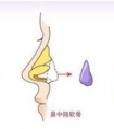 在廣州做自體軟骨隆鼻貴不貴
