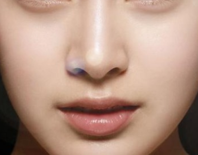 軟骨隆鼻手術(shù)有什么缺點(diǎn)嗎