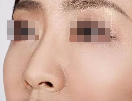 軟骨隆鼻手術(shù)的優(yōu)點有哪些