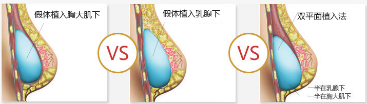 假體隆胸多久變得柔軟