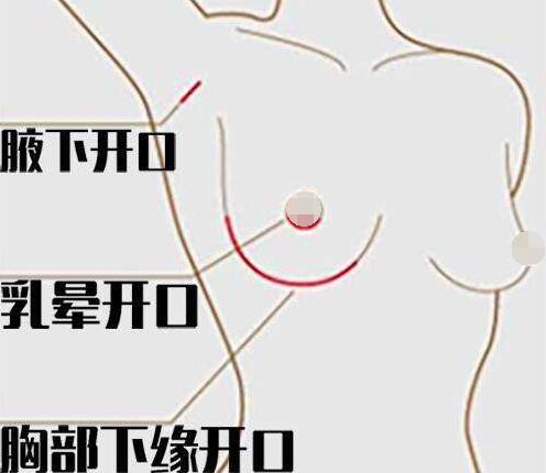 假體豐胸的疤痕大嗎