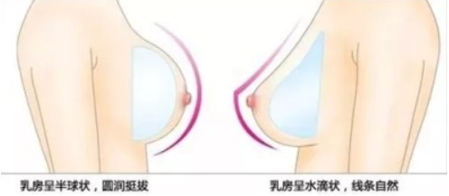 假體隆胸取出后會(huì)下垂嗎