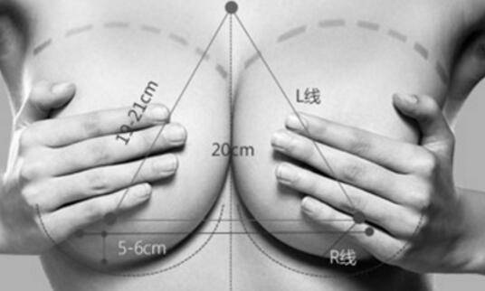 做自體脂肪隆胸需要住院嗎