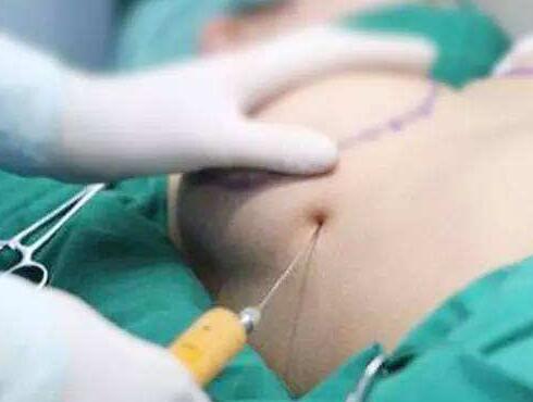 脂肪細(xì)胞注射到胸部后多久才能穩(wěn)定 