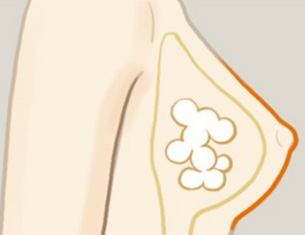自體脂肪豐胸后會(huì)影響哺乳健康嗎