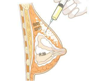 自體脂肪豐胸時(shí)間長(zhǎng)了效果會(huì)消失嗎