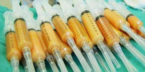 自體脂肪豐胸安全嗎