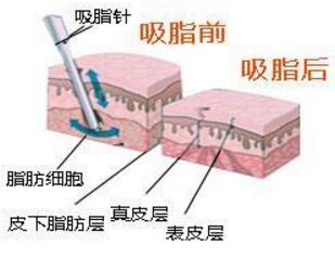 吸脂減肥費(fèi)用大概是多少