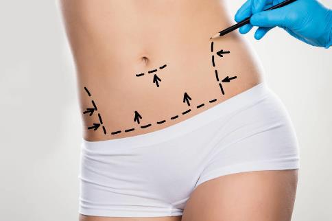 一般抽脂要多少錢