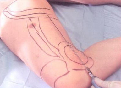 抽脂減肥后會凹凸不平嗎