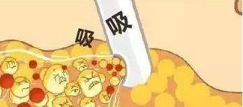 吸脂減肥的恢復(fù)期要多久