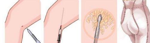 吸脂減肥手術(shù)后多久能運(yùn)動(dòng)