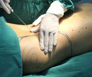 廣州吸脂減肥的價格貴不貴