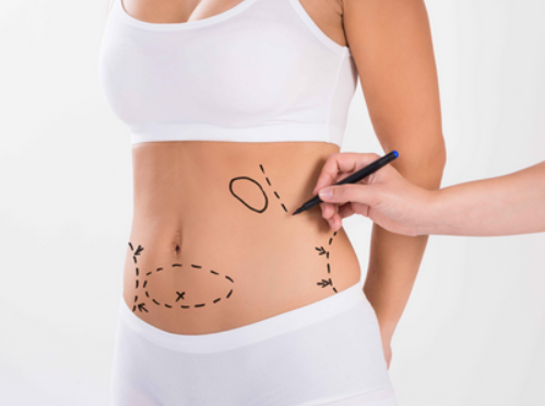 吸脂減肥后會(huì)有血腫嗎