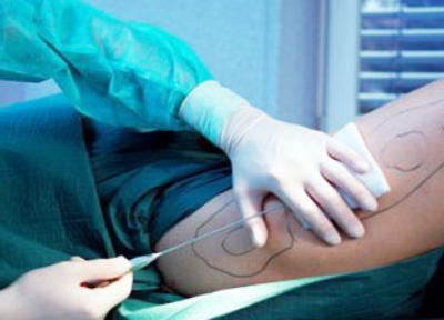 吸脂減肥手術安全嗎