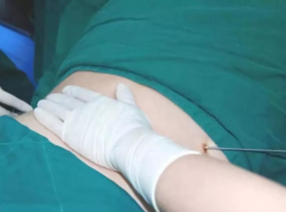 腰腹部脂肪贅肉明顯怎么快速減掉