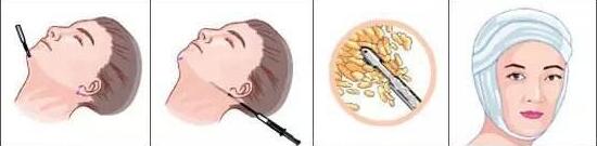 吸脂瘦臉會有凹凸不平的后遺癥嗎