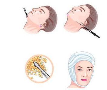 臉部吸脂要多少錢