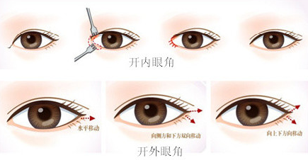 做開眼角手術(shù)的風(fēng)險大不大