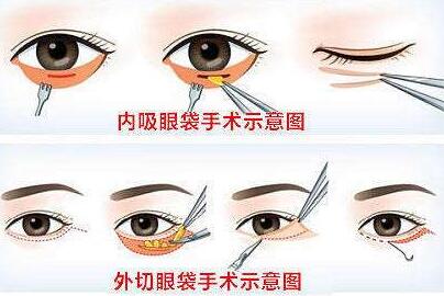 開(kāi)眼角手術(shù)是不是越大越好看呢