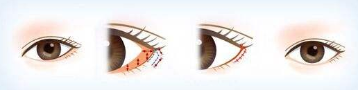 開外眼角需要多少錢