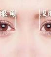 開眼角手術(shù)需要多少錢