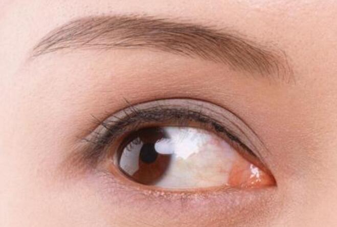 開眼角手術(shù)容易出現(xiàn)的風(fēng)險(xiǎn)