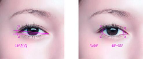 開眼角常見的后遺癥風(fēng)險(xiǎn)