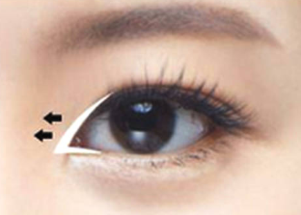 開眼角手術(shù)一般多少錢