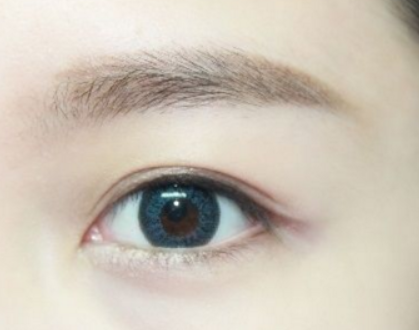 近視眼可以開眼角嗎