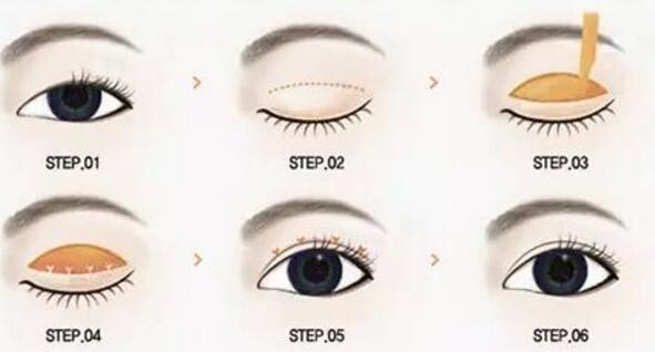 全切雙眼皮術后需要注意的護理事項