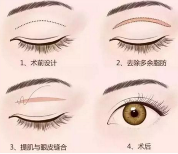 做雙眼皮手術(shù)會(huì)有什么風(fēng)險(xiǎn)