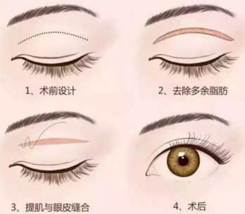 全切雙眼皮會影響視力健康嗎