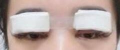 做雙眼皮手術后能戴眼鏡嗎